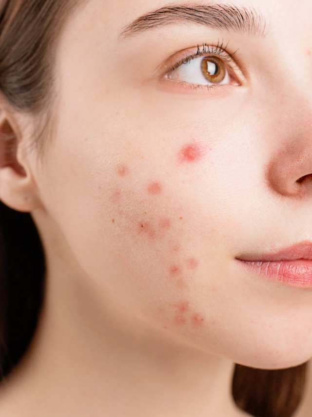 चेहरे पर अगर बार बार Pimples आते हैं तो अपनाये ये तरीका